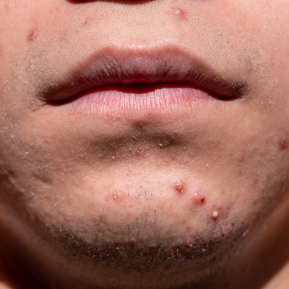 Man caring for acne-prone skin on the face and back