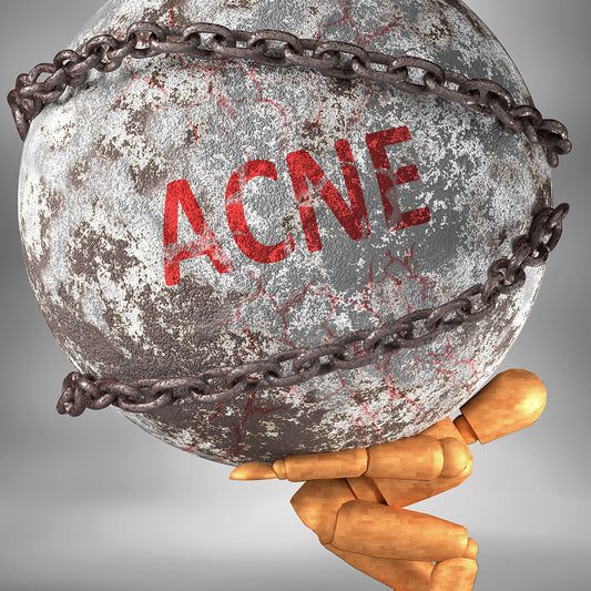 Woman managing stress-related acne with natural skin care