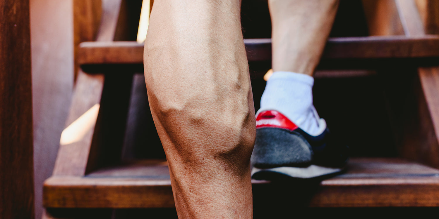 Visible varicose veins on leg — varicose veins and fitness