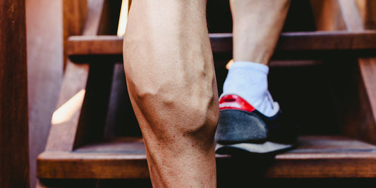 Visible varicose veins on leg — varicose veins and fitness