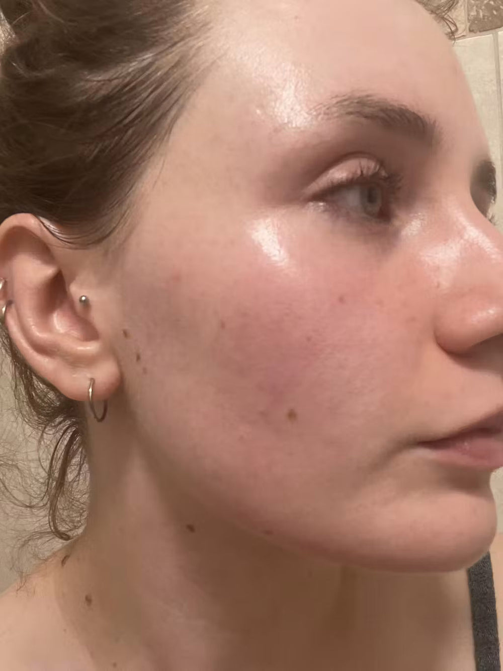acne US keep