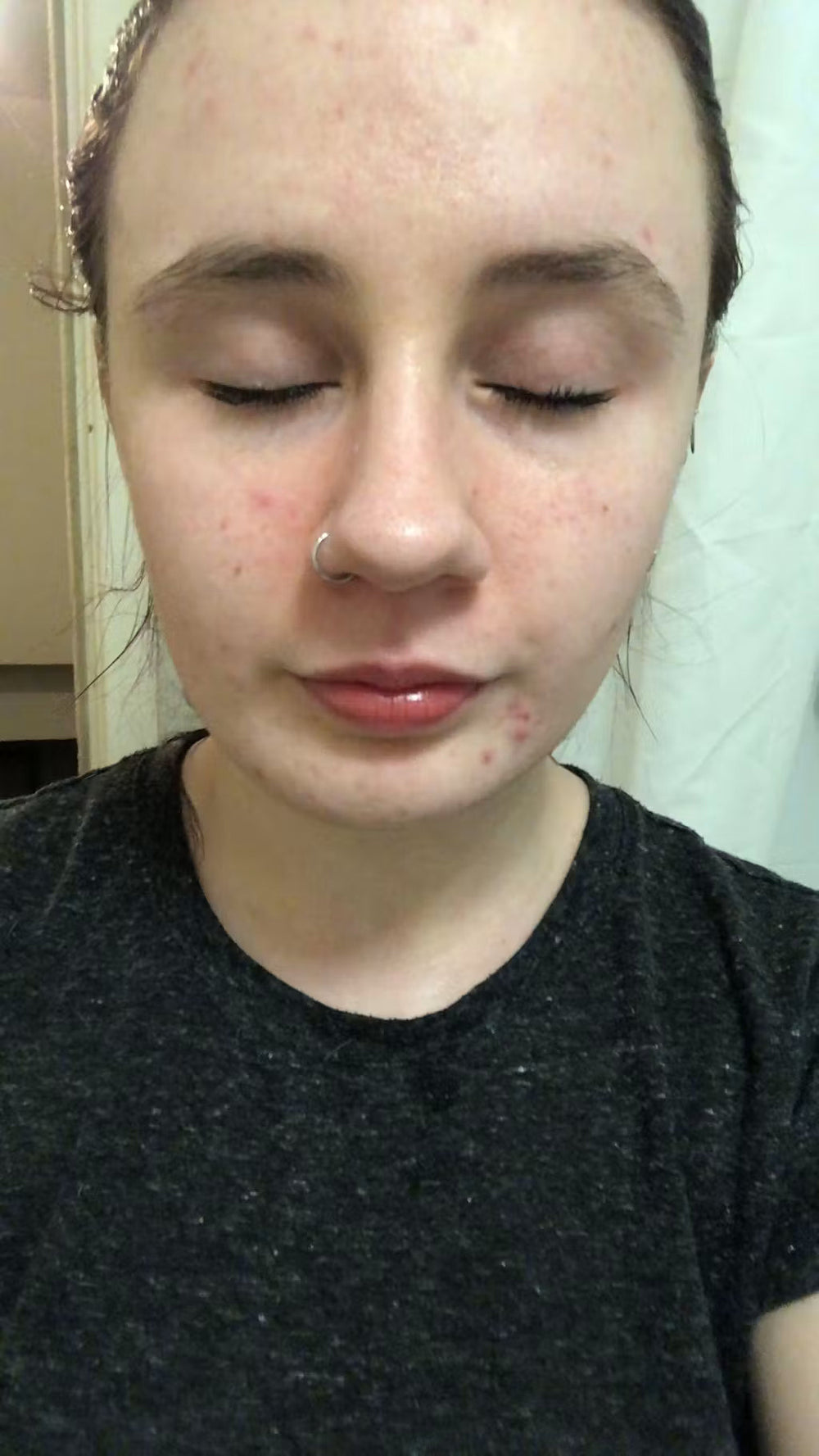 acne US keep